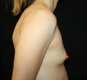 Breast Augmentation - Shaped Silicone Implants Before & After Patient #26494