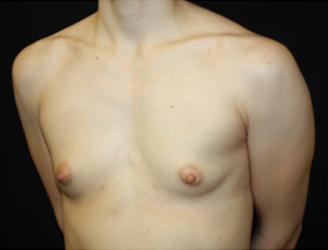 Breast Augmentation - Shaped Silicone Implants Before & After Patient #26494