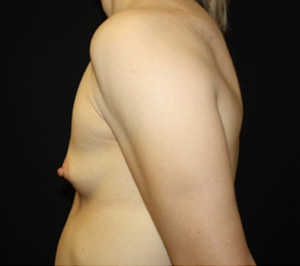 Breast Augmentation - Shaped Silicone Implants Before & After Patient #26494