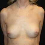 Breast Implant Exchange Before & After Patient #26638