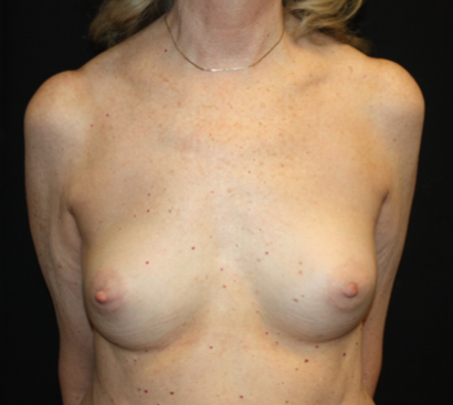 Breast Implant Exchange Before & After Patient #26638