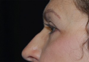 Blepharoplasty and Brow Lift Before & After Patient #25422