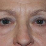 Blepharoplasty and Brow Lift Before & After Patient #25422
