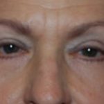 Blepharoplasty and Brow Lift Before & After Patient #25422
