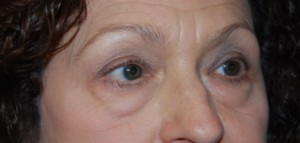 Blepharoplasty and Brow Lift Before & After Patient #25422