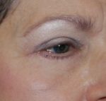 Blepharoplasty and Brow Lift Before & After Patient #25422