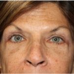 Blepharoplasty and Brow Lift Before & After Patient #25433