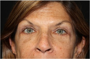 Blepharoplasty and Brow Lift Before & After Patient #25433