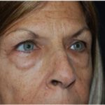 Blepharoplasty and Brow Lift Before & After Patient #25433