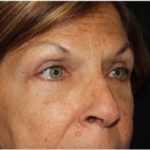 Blepharoplasty and Brow Lift Before & After Patient #25433