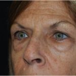 Blepharoplasty and Brow Lift Before & After Patient #25433