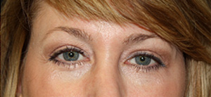 Blepharoplasty and Brow Lift Before & After Patient #25440