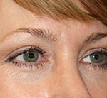 Blepharoplasty and Brow Lift Before & After Patient #25440