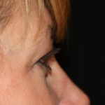 Blepharoplasty and Brow Lift Before & After Patient #25440