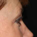 Blepharoplasty and Brow Lift Before & After Patient #25440