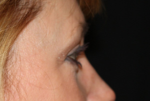 Blepharoplasty and Brow Lift Before & After Patient #25440