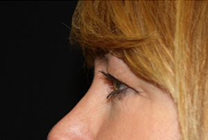 Blepharoplasty and Brow Lift Before & After Patient #25440