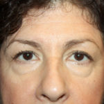 Blepharoplasty and Brow Lift Before & After Patient #25451