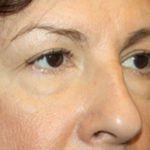 Blepharoplasty and Brow Lift Before & After Patient #25451