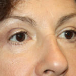 Blepharoplasty and Brow Lift Before & After Patient #25451