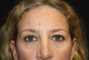 Blepharoplasty and Brow Lift Before & After Patient #25462