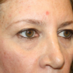 Blepharoplasty and Brow Lift Before & After Patient #25462
