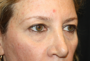 Blepharoplasty and Brow Lift Before & After Patient #25462