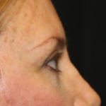 Blepharoplasty and Brow Lift Before & After Patient #25462