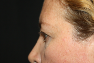 Blepharoplasty and Brow Lift Before & After Patient #25462