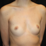 Breast Augmentation - Round Silicone Implants Before & After Patient #25586