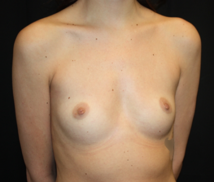 Breast Augmentation - Round Silicone Implants Before & After Patient #25586