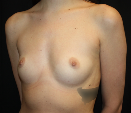 Breast Augmentation - Round Silicone Implants Before & After Patient #25586