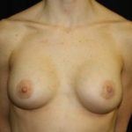 Breast Lift with Implant Before & After Patient #26925