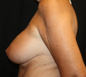 Breast Lift with Implant Before & After Patient #26993