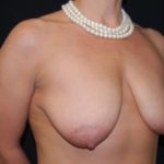 Breast Lift with Implant Before & After Patient #26838
