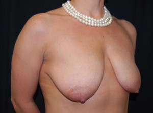 Breast Lift with Implant Before & After Patient #26838