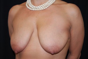 Breast Lift with Implant Before & After Patient #26838