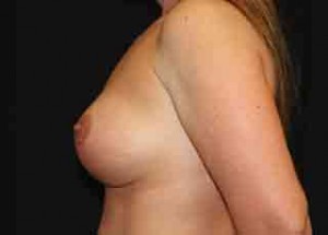 Breast Lift with Implant Before & After Patient #26717