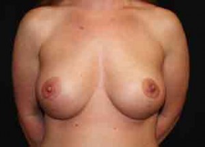 Breast Lift with Implant Before & After Patient #26717