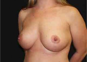 Breast Lift with Implant Before & After Patient #26717