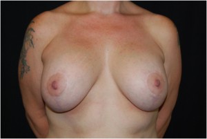 Breast Lift with Implant Before & After Patient #26898