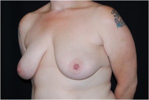 Breast Lift with Implant Before & After Patient #26898