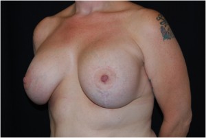 Breast Lift with Implant Before & After Patient #26898