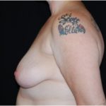 Breast Lift with Implant Before & After Patient #26898