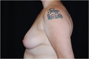 Breast Lift with Implant Before & After Patient #26898
