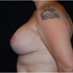 Breast Lift with Implant Before & After Patient #26898