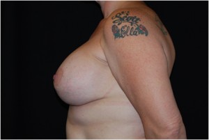 Breast Lift with Implant Before & After Patient #26898