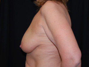 Breast Lift with Implant Before & After Patient #26916