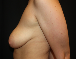 Breast Lift with Implant Before & After Patient #26943