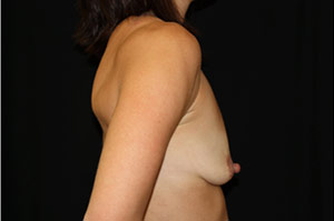 Breast Lift with Implant Before & After Patient #26962
